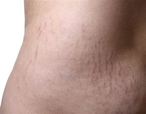 How To Handle Stretch Marks After Weight Loss
