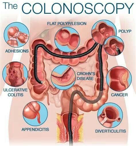 Colonoscopy Colon Cancer Infographic Gastroenterology Nclex Rn