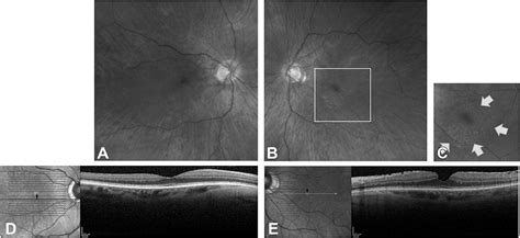 Binocular Diplopia Caused By An Epiretinal Membrane With Fov
