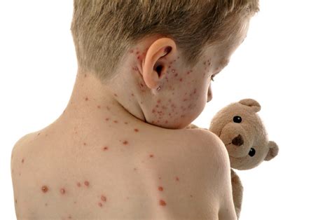Measles Pediatric Associates Of Charlottesville