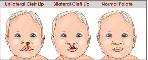 Cleft Lip Cleft And Craniofacial Institute Of Utah