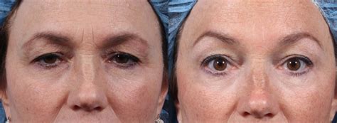 The above gallery of before and after botox pictures will give you an idea of exactly what sort of affect this product has. Botox and Dysport in NYC | Dr. Brett Kotlus Oculoplastic ...
