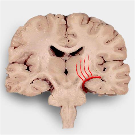 This report describes, for what may be only the second time, a ruptured miliary aneurysm within a cerebral. Hypertensive basal ganglial bleed | Image | Radiopaedia.org