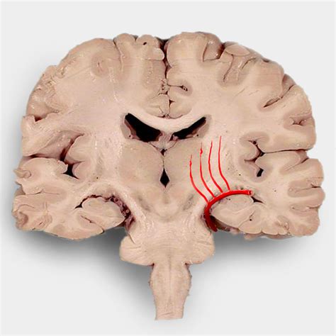 The basal ganglia are a group of neurons below the cerebral cortex that are mainly involved in motor function and the planning of directed movement. Hypertensive basal ganglial bleed | Image | Radiopaedia.org