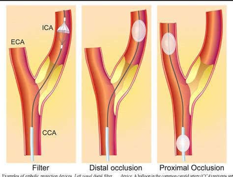 State Of The Art In Carotid Artery Stenting Trial Data Technical