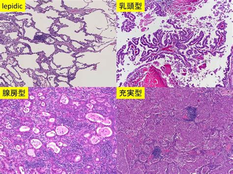 1 definitions matched, 1 related definitions, and 0 example sentences definition of 肺浸潤. 腺癌