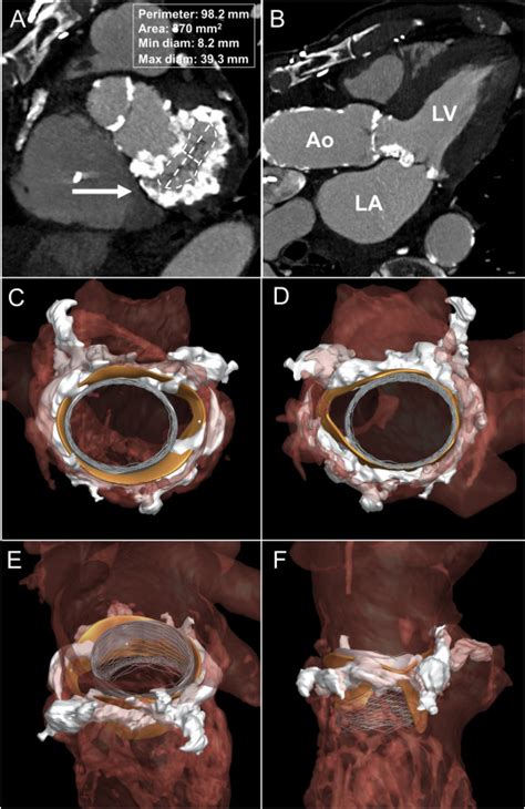 Transcatheter Mitral Valve Replacement In Mitral Annulus Calcification