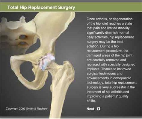 Total Hip Replacement Surgery Procedure Dr Niraj Vora