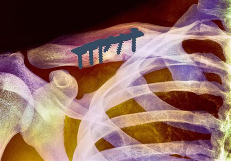 Pinned Collar Bone Fracture X Ray Photograph By Fine Art America