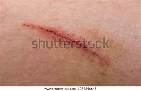 Wound On Human Body Suture Old 스톡 사진지금 편집 1072646648