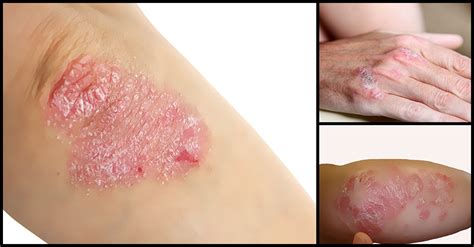 A Complete Guide To Psoriasis The Dos And Donts Dr Farrah Md
