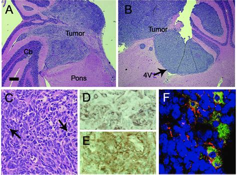 Histopathology Of Medulloblastomas Induced By C Myc Plus Shh A B Download Scientific Diagram