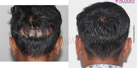 Back Head Before And After