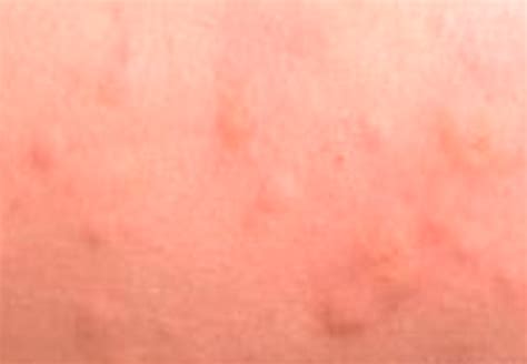 Viral Infection Rash Pictures Causes Symptoms Treatment