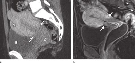 A Sagittal Ct Image Obtained During The Portal Venous Phase