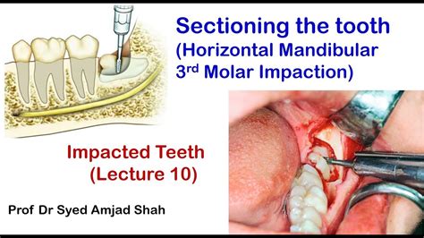 Sectioning Cutting The Tooth Horizontal Mandibular Third Molar