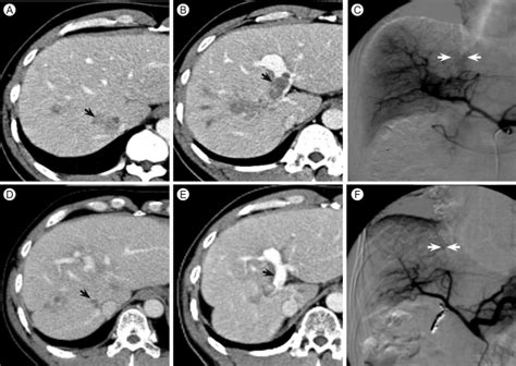 Abdominal Computed Tomography Ct Scan Reveals A Diffuse Infiltrative