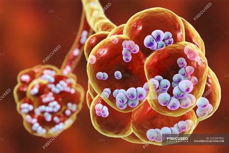 Digital Artwork Of Streptococcus Pneumoniae Bacteria Inside Alveoli Of
