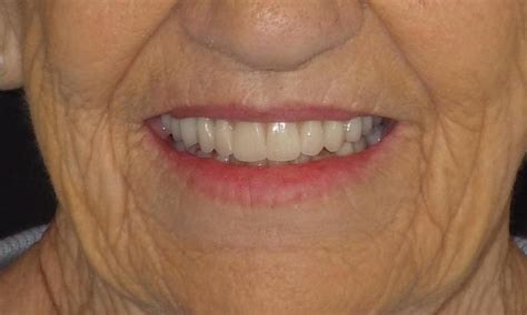 Duxbury Ma Dentist Smile Gallery Dentures