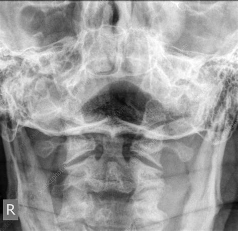 Normal Cervical Spine X Ray Stock Image C0197258 Science Photo