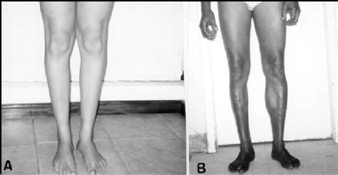 A Case 20 Wasting Of Muscles Of Right Leg B Case 3 Atrophy Of