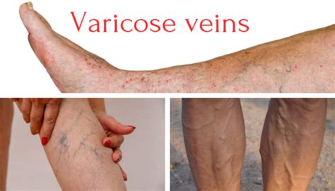 Varicose Veins In Legs Drabhilash Sandhyala Vascular Surgeon