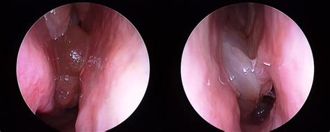 Approximately 30% of patients with nasal polyps test positive for environmental allergies. Nasal polyps | Prof Richard Harvey