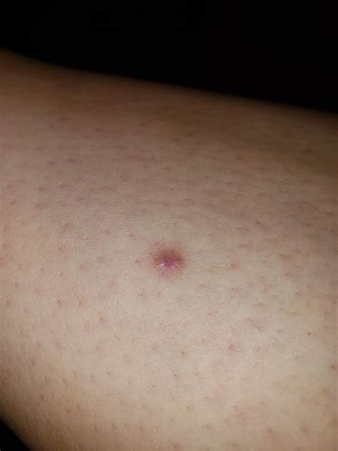 Strange Bump On Shin Ingrown Hair Has Been There For Years Derm Says