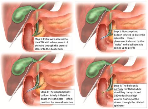 Making Common Duct Exploration Common Balloon Sphincteroplasty As An