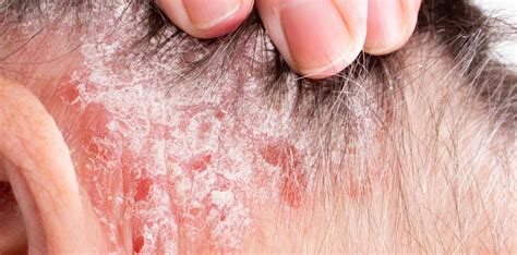 The Link Between Eczema And Hair Loss How Hair Transplants Can Help
