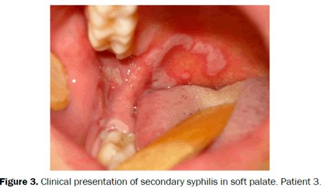 Pity That Tertiary Syphilis Symptoms Sorry