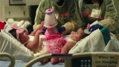 Surgery Separates Infant Conjoined Twins In Texas Abc7 Chicago