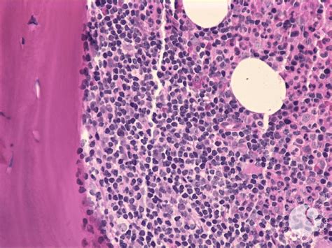 Follicular Lymphoma Bone Marrow Biopsy 3