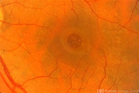 Macular Hole Retina Image Bank