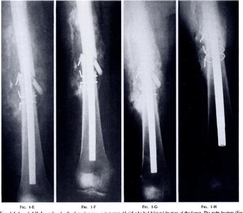 Figure 1 From Fractures Of The Femur Treated By Open And Closed