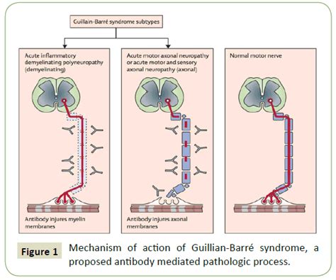 Severe Guillain Barré Syndrome Following Shingrix Vacc