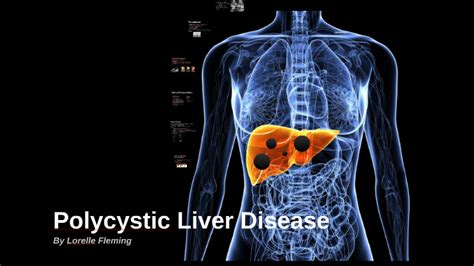 Polycystic Liver Disease By Lorelle Fleming