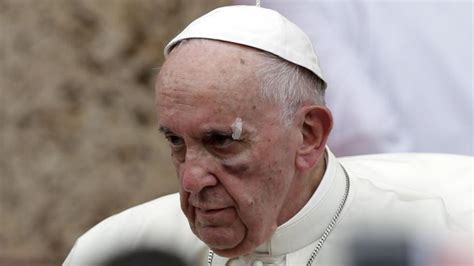 El Papa Francisco Se Ríe Del Golpazo Que Le Dejó El Ojo