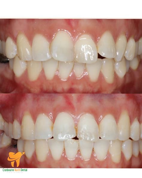Before And After Cranbourne North Dental