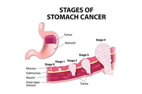 Unfortunately, this is the main reason. Stomach Cancers - Gastrointestinal Conditions - The GI Unit