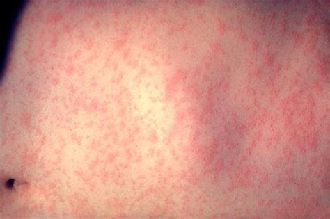Washington Gov Inslee Declares State Of Emergency Over Measles