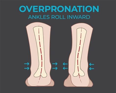 What Is The Difference Between Overpronation And Underpronation Dr