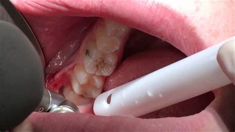 What To Expect And Important Care Tips After A Wisdom Tooth Extraction Mahmoud Fx