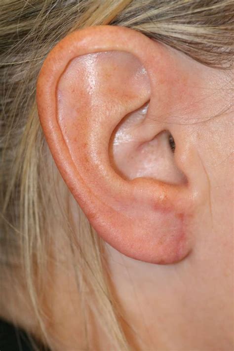 Ear And Ear Lobe Reduction For Macrotia Big Ears Ear Lobes