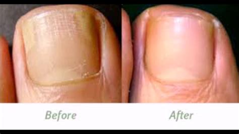 how effective is coconut oil for japanese toenail fungus laser treatment youtube