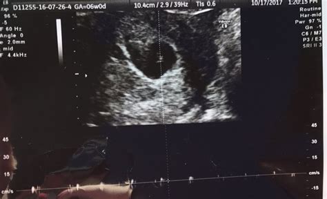 First Ultrasound Babycenter