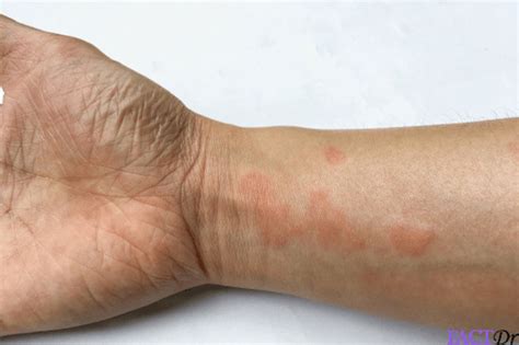 Lupus Rash Skin Face Legs Treatment Discoid Itchy Factdr