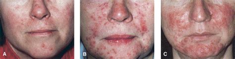 Rosacea Dermatology Matters