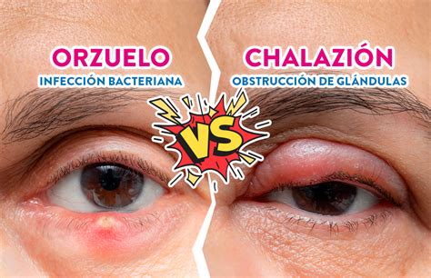 ¿cuál Es La Diferencia Entre El Orzuelo Y Chalazión Vidavisión