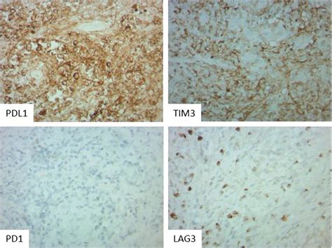 Immunohistochemical Markers Of Immune Checkpoints Showing Positivity